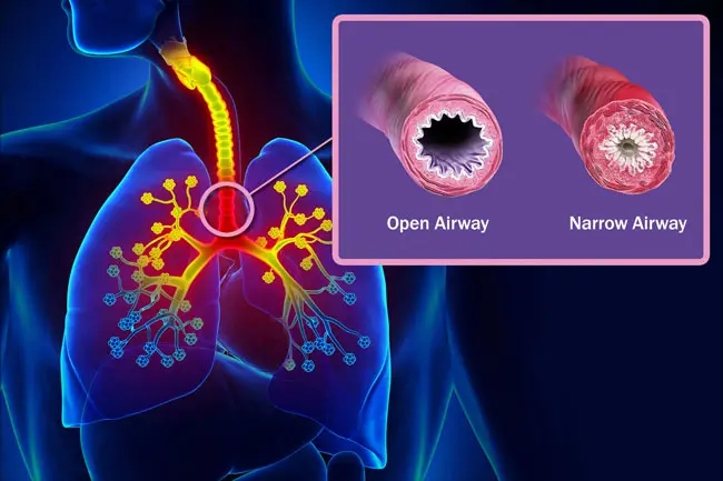 During an asthma attack, the airways in and out of your lungs narrow and your body makes extra mucus, both of which make it hard for you to breathe. 