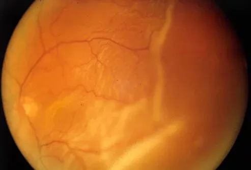 Detached retina is a serious medical emergency. 