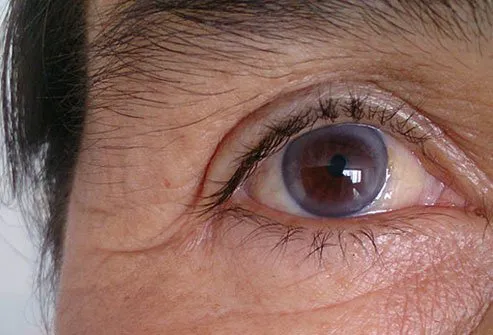 Arcus senilis is a ring of calcium and cholesterol that appears around the cornea of the eye. 