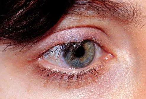 Eyelids may turn inward or outward as people age. 