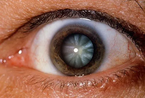 A cataracts is a cloudy growth that covers the lens of the eye. 