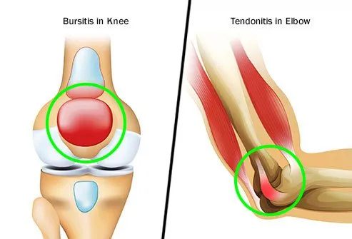 Inflammation can lead to permanent joint injury.