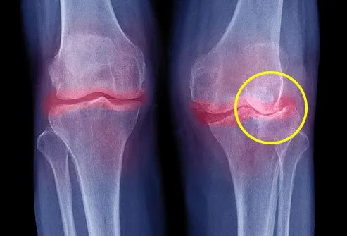 Osteoarthritis is the most common joint problem in America.