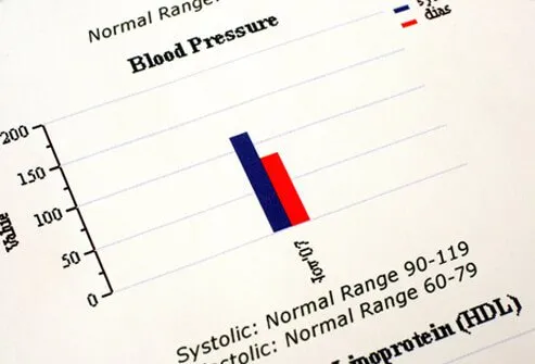 Picture of Low Blood Pressure (Hypotension)