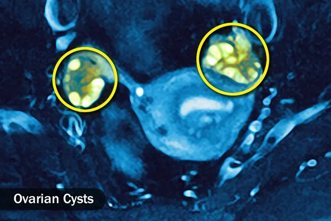 Excess androgen may lead to polycystic ovarian syndrome and weight gain. 