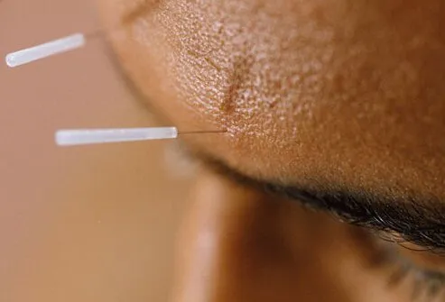 Some patients’ headaches may respond well to this Chinese method of inserting needles.