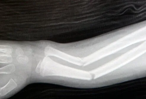 Picture of Stress Fracture