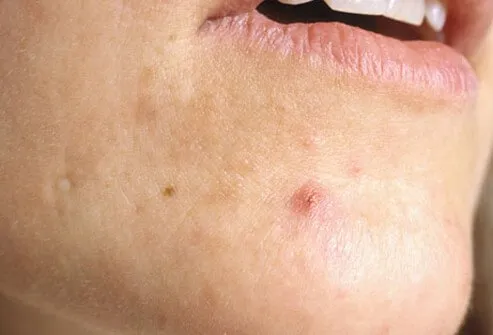 Acne is one of the most common signs of PMS, and it doesn't just affect teenagers.