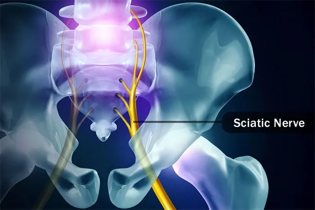 Inactivity may irritate and inflame the sciatic nerve. 