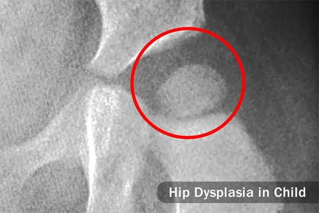 Hip dysplasia is another potential cause of hip pain. 