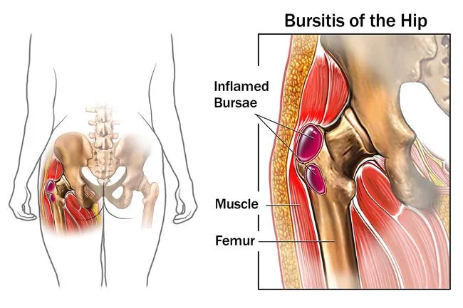 Bursitis can cause sharp, intense hip pain. 