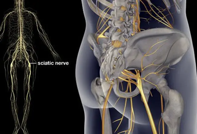 Sciatica is a pain that radiates from the low back down a lower extremity; it is caused by irritation of the sciatic nerve.