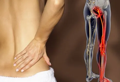 Low back pain that radiates to the hip, buttock, and down a lower extremity is the most common symptom of sciatica.