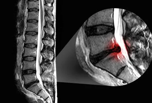 Disk herniation is a common cause of sciatica.