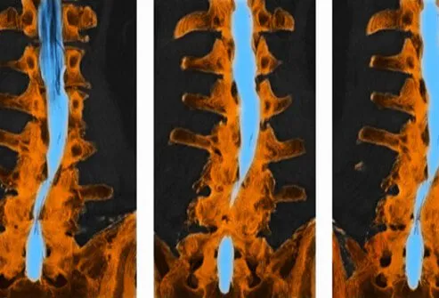 Degeneration of the vertebrae of the spine can lead to narrowing of the spinal canal; this is called spinal stenosis.