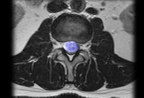 Tumors are rare causes of sciatica when they put direct pressure on the sciatic nerve or its nerve roots.