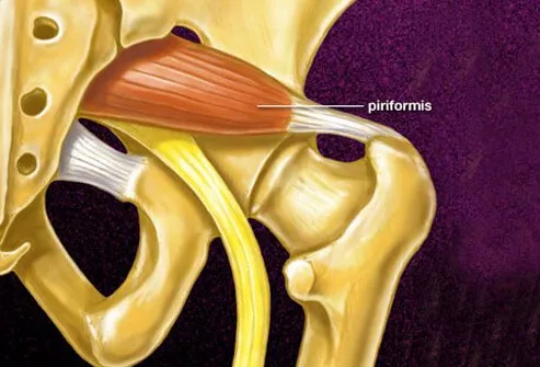 The piriformis muscle in the buttock can sometimes lead to irritation of the sciatic nerve.