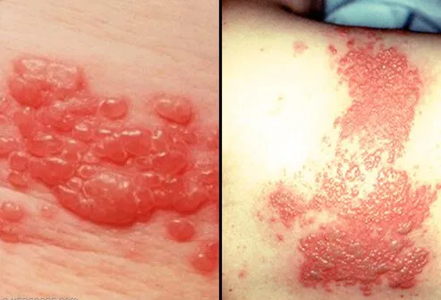 Shingles rashes have patches of tiny red blisters.