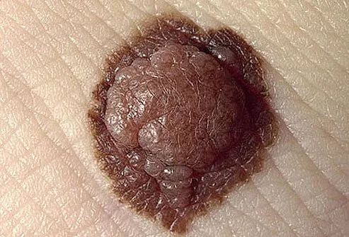 Pigmented and raised atypical mole.