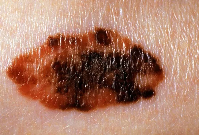 Collage of melanoma.