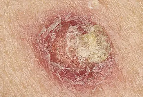 Close-up of squamous cell carcinoma.