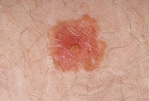 Close-up of Bowen Disease skin lesion,