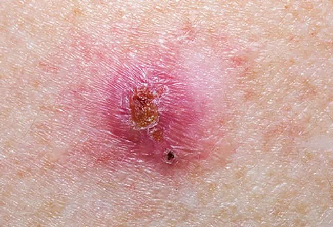 Collage of basal cell carcinoma.