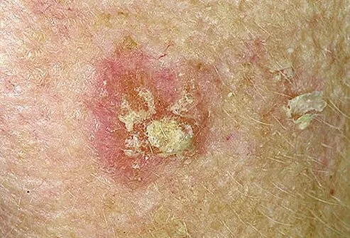 Actinic keratoses are scaling, horny, red, tender bumps present in sun-exposed areas.