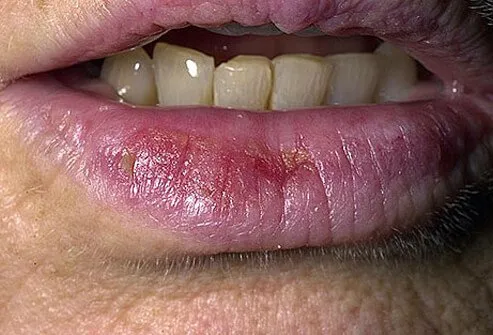 Close-up of actinic cheilitis on lower lip.