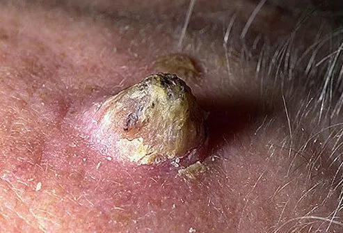 Close-up of cutaneous horn on scalp of elderly man