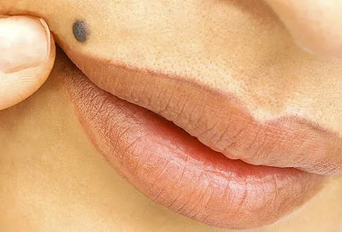 Benign nevus, or mole, above a woman's lip