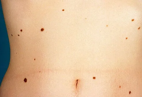 Atypical nevi, or moles, on female torso