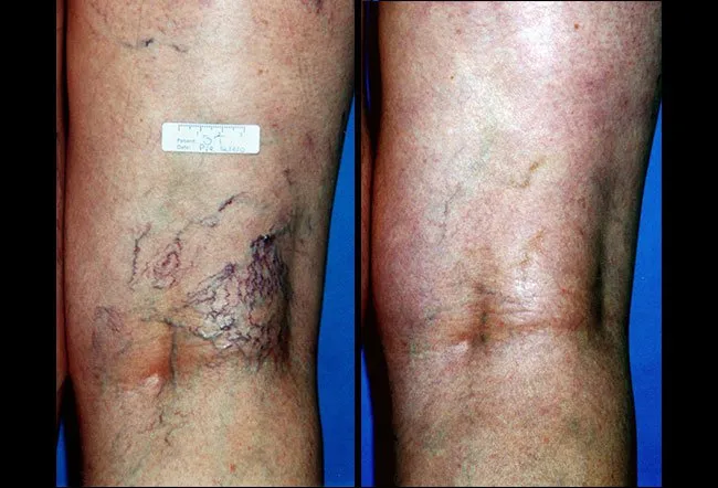 Treatment with sclerotherapy can require multiple treatment sessions, and healing time may vary from person to person.