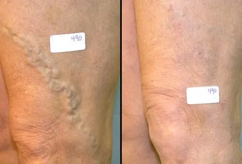 Vein ligation and stripping is frequently successful at resolving both the symptoms and cosmetic appearance of varicose veins. 