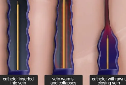 Endovenous radiofrequency ablation is a minimally invasive procedure that is similar to endovenous laser treatment.