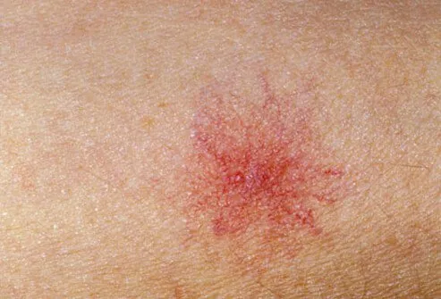 Spider veins (also called telangiectasias) are clusters of tiny blood vessels that develop close to the surface of the skin.