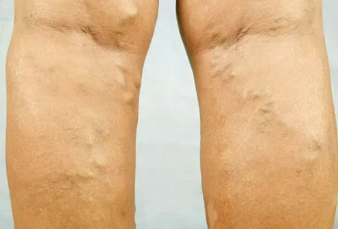 Varicose veins are abnormally enlarged veins that appear most often on the legs.