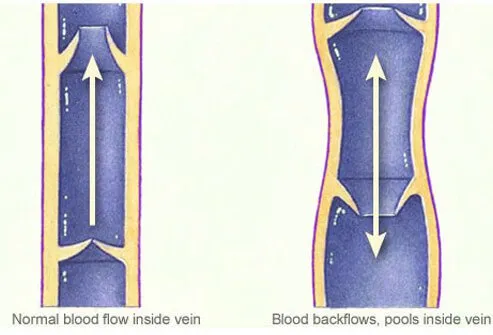 Spider veins and varicose veins are caused by structural abnormalities of blood vessels.