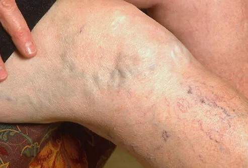 Spider veins and varicose veins often cause no symptoms or signs other than their undesirable cosmetic appearance.