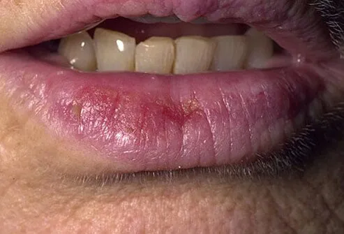 Actinic cheilitis is related to actinic keratosis, but it appears on the lower lips.