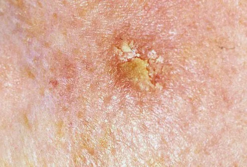 Actinic keratosis is the name for small, scaly red or brown papules that are the result of excessive sun exposure.