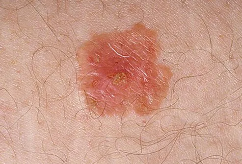 It is a noninvasive skin cancer that stays on the skin's surface.