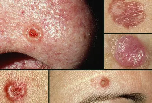 Basal cell carcinoma is the most common form of skin cancer.