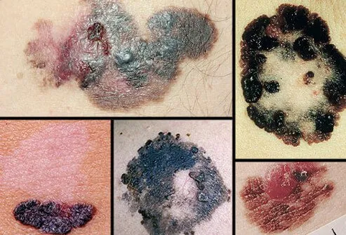 Melanoma causes the vast majority of skin cancer deaths.