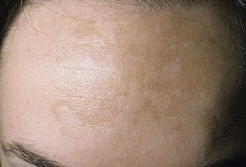 Melasma (chloasma) is an abnormal patch of brown skin on the cheeks, nose, or forehead, usually developing during pregnancy.