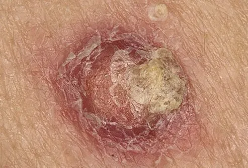 A photo of a squamous cell carcinoma lesion.