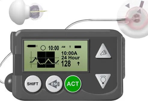 This system consists of a tiny sensor under the skin to check blood sugar levels.