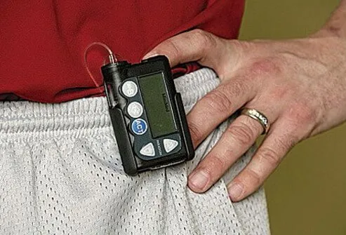 Although many people administer insulin through several shots per day, some people can use an insulin pump.