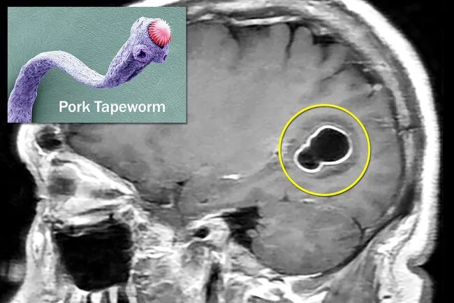 Infection with pork tapeworm may lead to cysts in the brain, muscles, liver, and other organs.