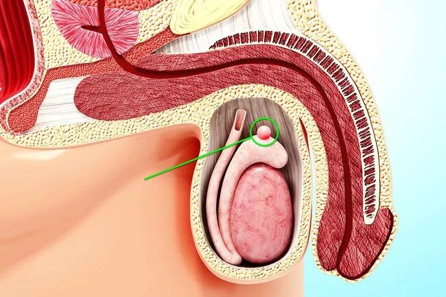 A cyst inside the epididymis is called a spermatocele.